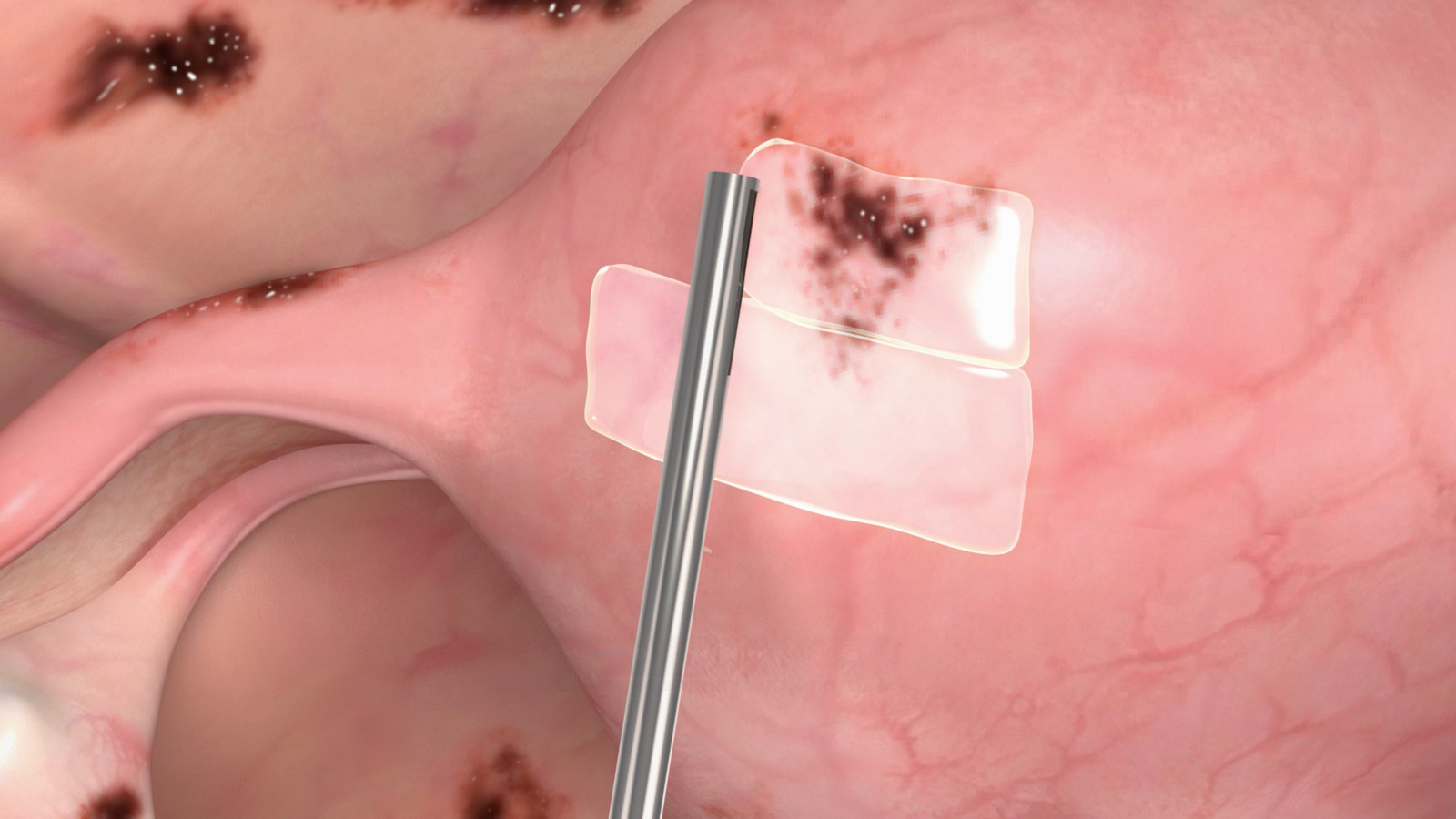 barriere-anti-adherence-2